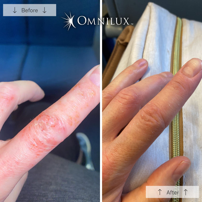 Omnilux Contour Glove LED Light Therapy Hand Rejuvenation Device