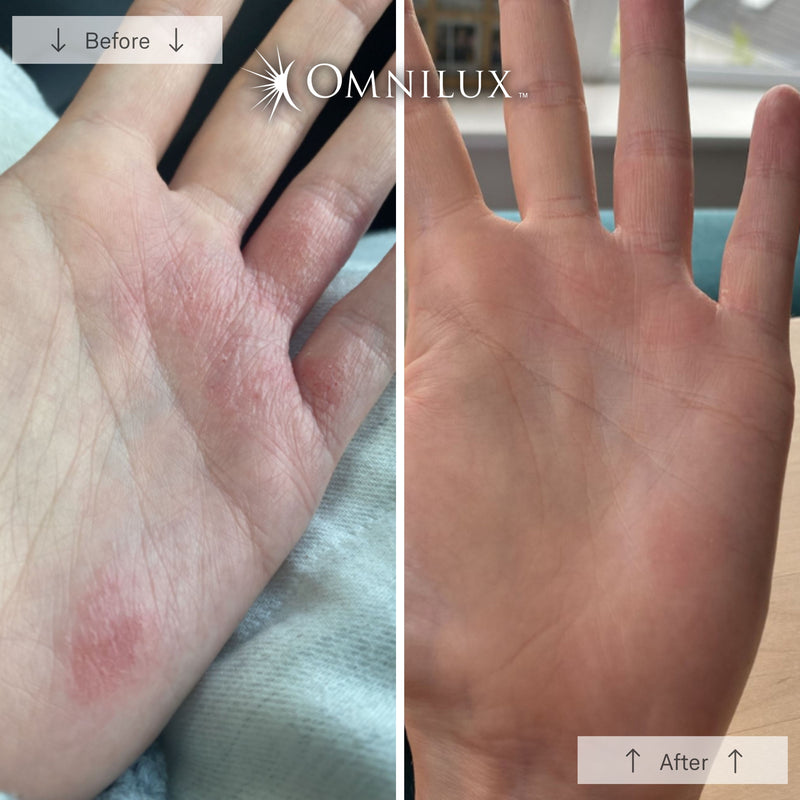 Omnilux Contour Glove LED Light Therapy Hand Rejuvenation Device