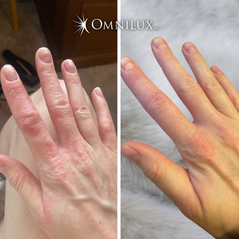 Omnilux Contour Glove LED Light Therapy Hand Rejuvenation Device